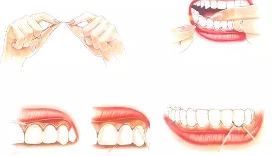 洗牙牙斑清除全过程,用哪种牙膏可以去牙斑