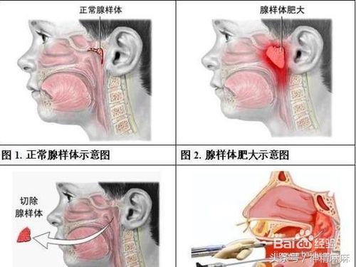腺样体肥大可以吃中药调理缩小吗,儿童腺样体肥大吃什么中成药调理