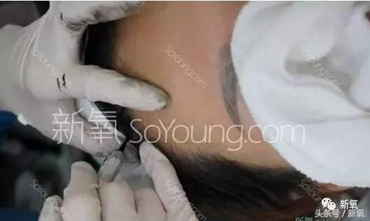 杨幂发际线还会回归吗,杨幂发际线秃到后脑勺