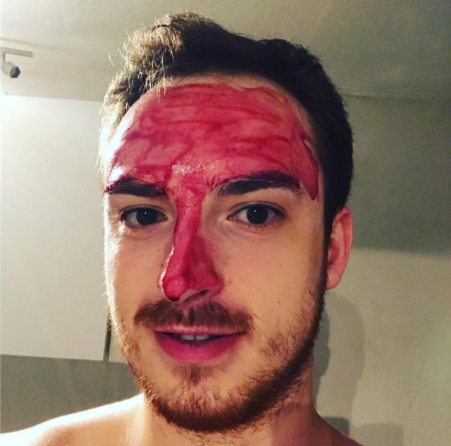 祛痘祛闭口粉刺黑头,如何有效的祛痘去黑头去闭口