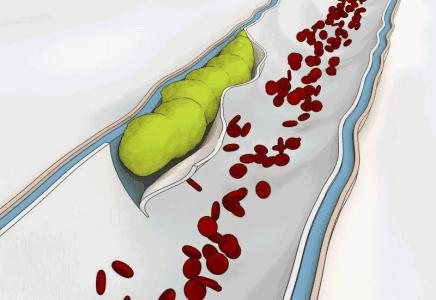 吃什么食物可以预防心脑血管堵塞,十大现象预示血管已堵塞