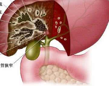 这项技术降低了那些无法承受手术病人的死亡率