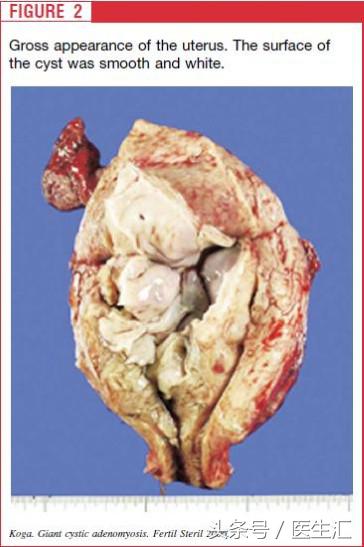从肌瘤剔除术到全子宫切除术，一个年轻姑娘的无奈
