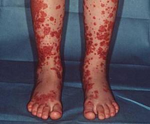 过敏性紫癜引起的腹痛症状及表现,过敏性紫癜会长小黑点吗