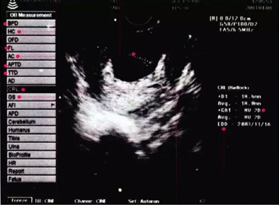 怀孕2个月了做腹部b超看得清楚吗,整个孕期大概做多少次b超