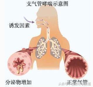 呼吸困难与气急气短区别,气短呼吸困难是什么原因