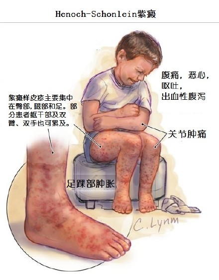 皮肤紫癜会发痒吗,过敏性紫癜出现发痒的疙瘩咋回事