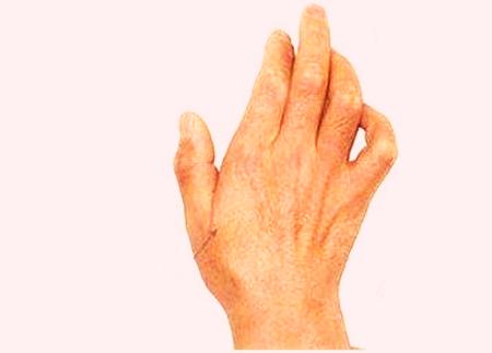 医生脊髓空洞了该怎么办,医生讲解脊髓空洞症最佳锻炼方式