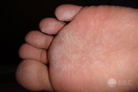 香港脚可以口服药物治疗吗