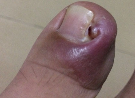 被甲沟炎反复折磨,被甲沟炎折磨了好几年