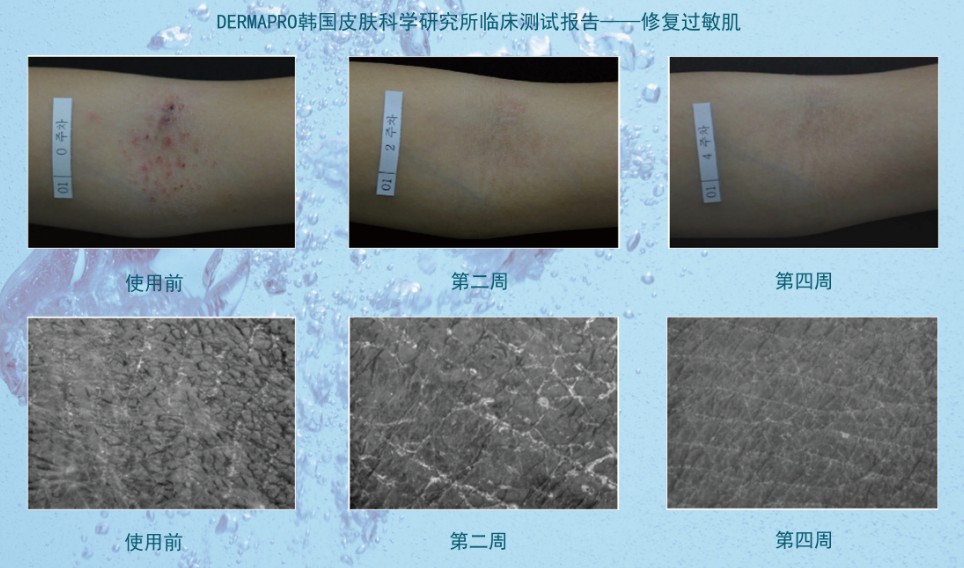 如何快速去除黑头,如何快速去除黑头和痘痘