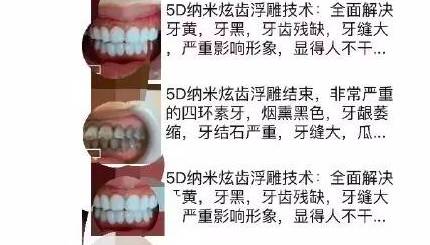 牙齿美白损伤最少的方法,想要牙齿美白这三招最管用