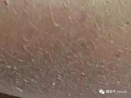 激素脸修复期很干脱皮正常吗,激素脸干燥起皮了怎么办