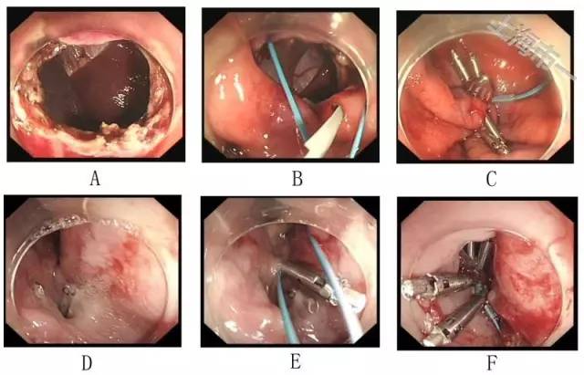 消化道穿孔诊治新进展,消化道穿孔内镜表现