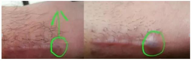 手术切口拆完线会疼吗,手术拆完线为什么还有一根线