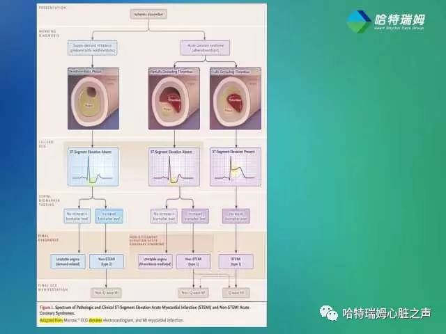 关于“急性心肌梗死”的科普,心肌梗死临床指南最新