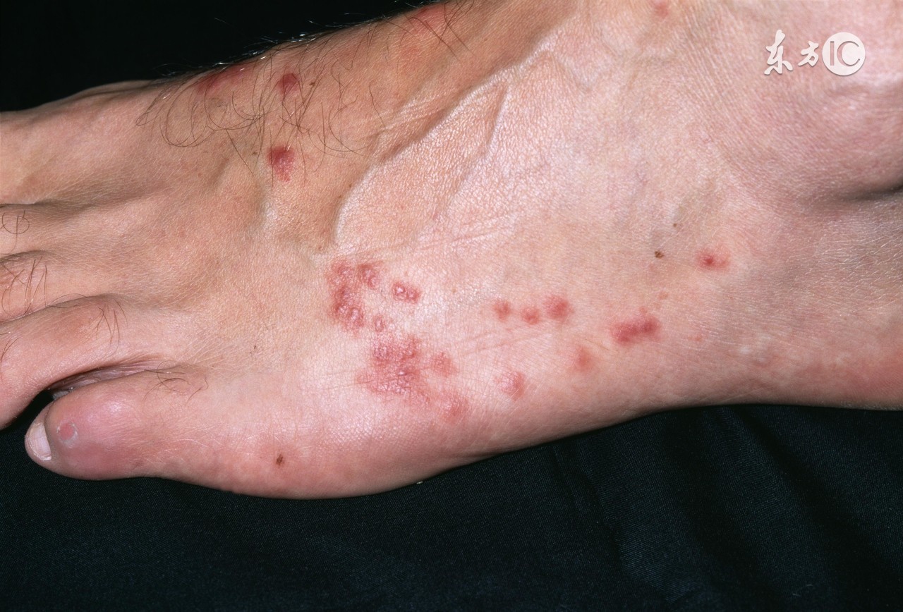 被水母蜇了怎么办小妙招,水母蜇人后抹什么药膏