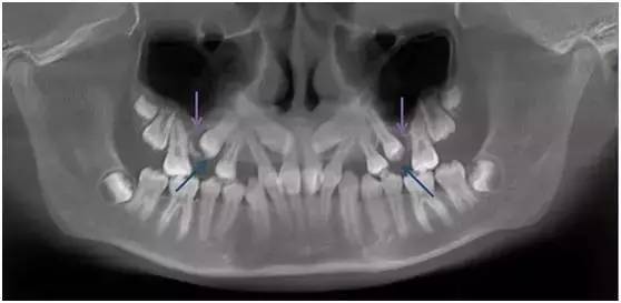 替牙期牙齿需要矫正吗,替牙期牙齿