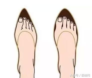 脚趾变成紫色了怎么办,脚趾形状变了是怎么回事