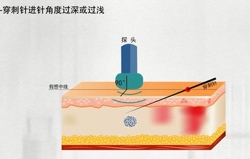乳腺活检穿刺术操作方法,乳腺活检是怎么弄的