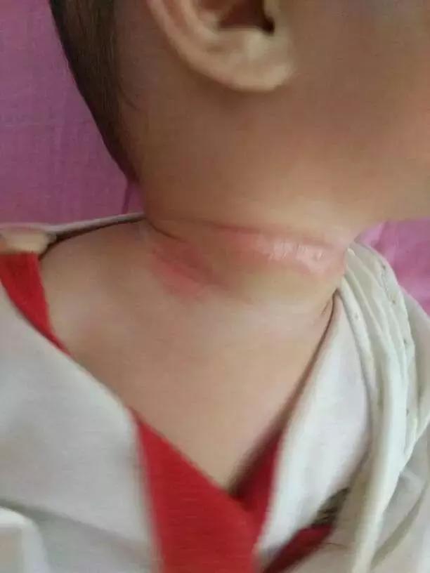 夏天来了脖子痒怎么办,夏天来了脖子上的颈纹怎么办