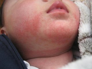 宝宝起湿疹是寒湿体质吗,湿疹如何加强皮肤屏障