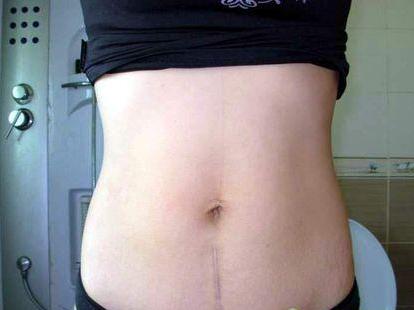 妈妈剖腹产怎么缝合,妈妈剖腹产宝宝出来怎样护理