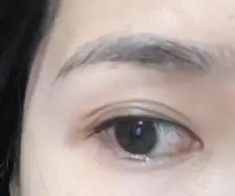 拿什么拯救术后三眼皮