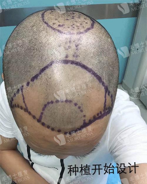 有白发植发和假发哪种好,植发和补发增发哪个好