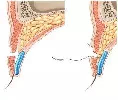 拿什么拯救术后三眼皮