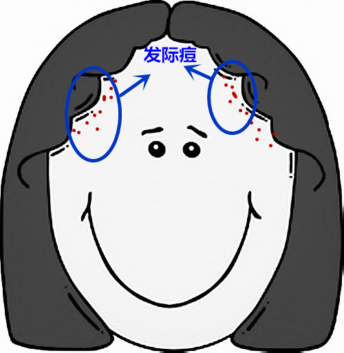 面部痘痘严重程度检测,痘痘面部分析