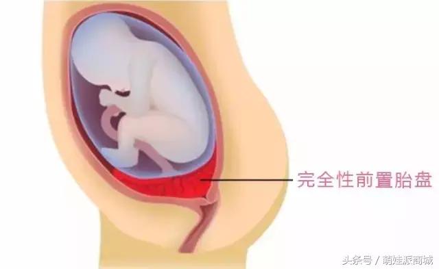 孕妇胎盘低怪谁,孕妇检查胎盘低是怎么回事