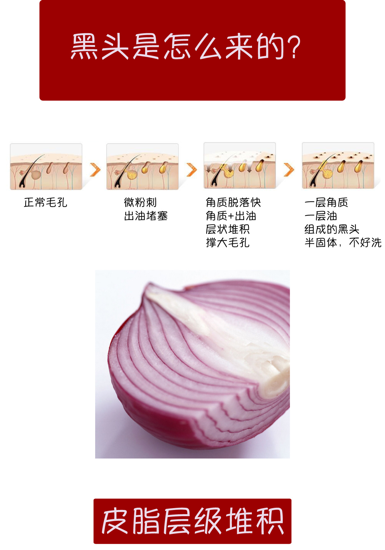 孩子长闭口粉刺怎么办,闭口粉刺总是长怎么办呢