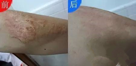 宝宝摔倒的伤疤怎样不留疤痕,宝宝摔倒怎么不留疤