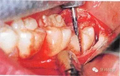 口腔拔牙图片,口腔拔牙麻醉多久消退