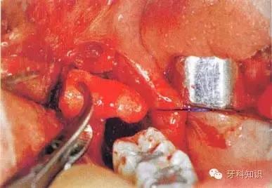 口腔拔牙图片,口腔拔牙麻醉多久消退