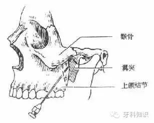 口腔拔牙图片,口腔拔牙麻醉多久消退