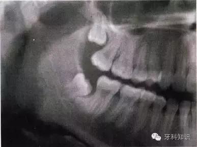 口腔拔牙图片,口腔拔牙麻醉多久消退