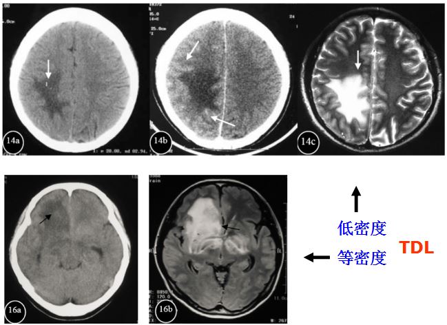 医学干货：瘤样炎性脱髓鞘病与胶质瘤、PCNSL临床、影像鉴别