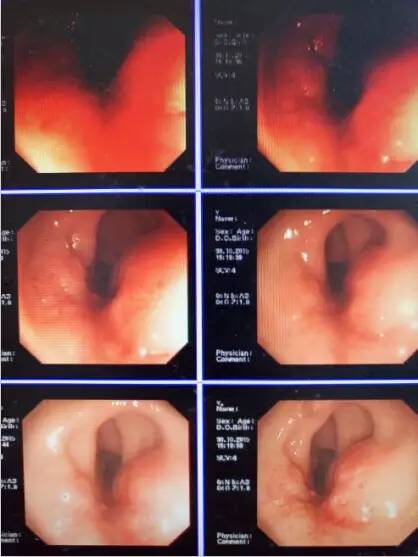 直肠神经内分泌肿瘤良性转移快吗,直肠神经内分泌瘤肝转移的后果