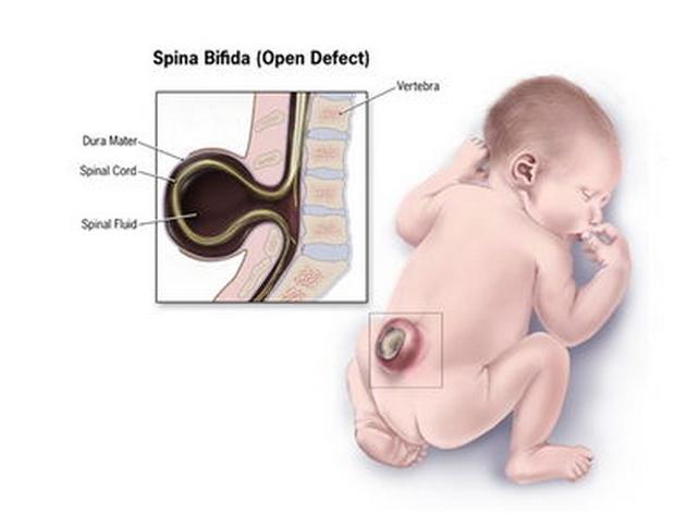 孩子脊柱裂有治疗办法吗,先天性脊柱裂有哪些症状
