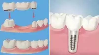 牙齿轻微缺损需要处理吗,牙齿楔状缺损修补多少钱