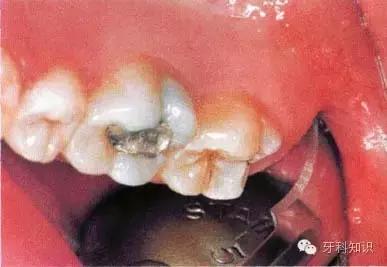 口腔拔牙图片,口腔拔牙麻醉多久消退