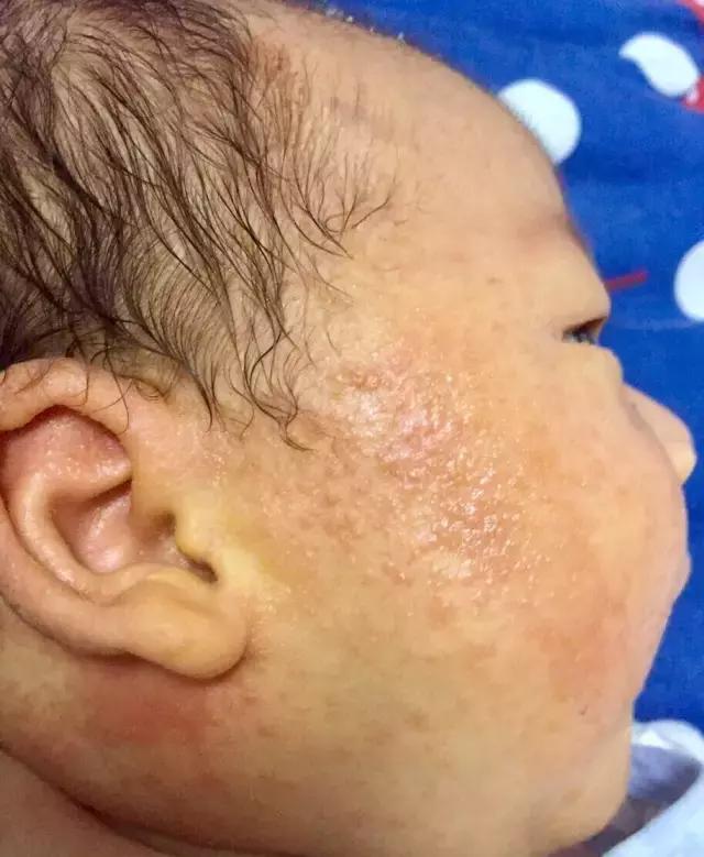 夏天身上总是各种「包」，对症下药，还你滑嫩肌肤！