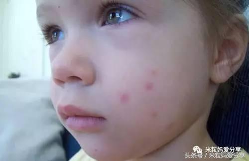 夏季宝宝驱蚊产品推荐,夏季宝宝驱蚊快来学几招