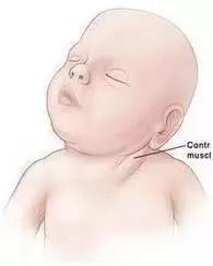 斜颈如何早发现,儿童斜颈怎么发现