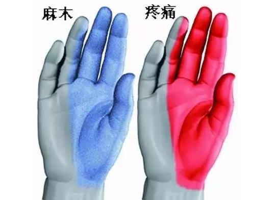 就医搜｜腕管综合征：容易在键盘上“敲”出的疾病！