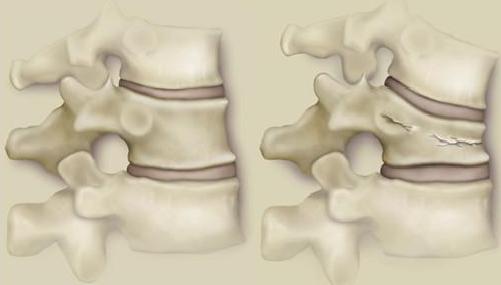 宣武医院肠梗阻,老王摔了一跤断了两根肋骨