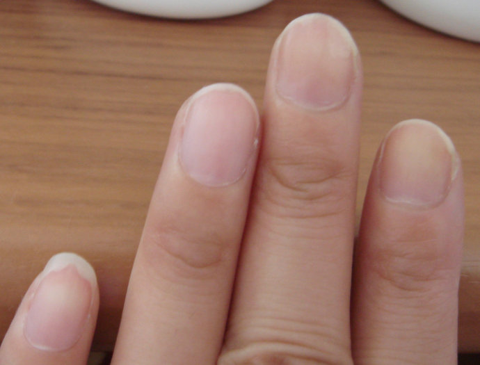 怎么看灰指甲有没有好转的迹象,得了灰指甲怎么判断是否治愈