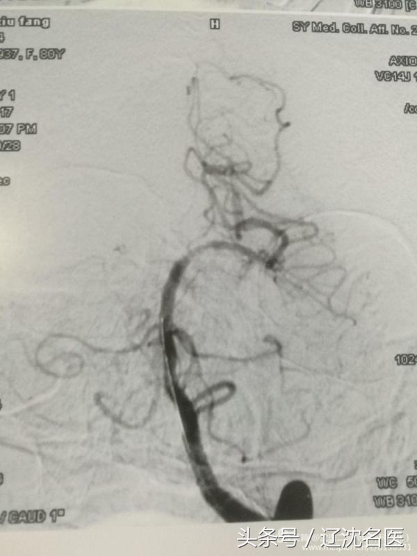 老人脑梗昏迷、大小便*禁失**，医生用这招救回一命！